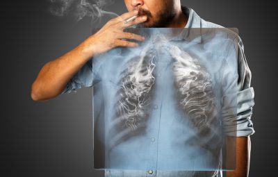 cigarro cancer pulmao hsm diagnosticos 400x255 - Consumo de tabaco é responsável por 90% dos casos de câncer de pulmão