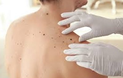 0606 Melanoma 400x255 - Junho Preto: melanoma é o câncer de pele mais comum e pode ser detectado com a Medicina Nuclear