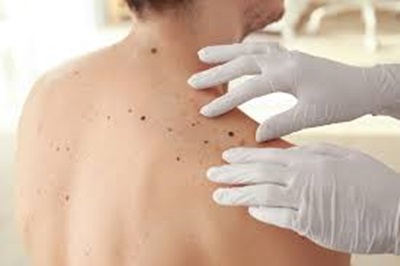 Junho Preto: melanoma é o câncer de pele mais comum e pode ser detectado com a Medicina Nuclear