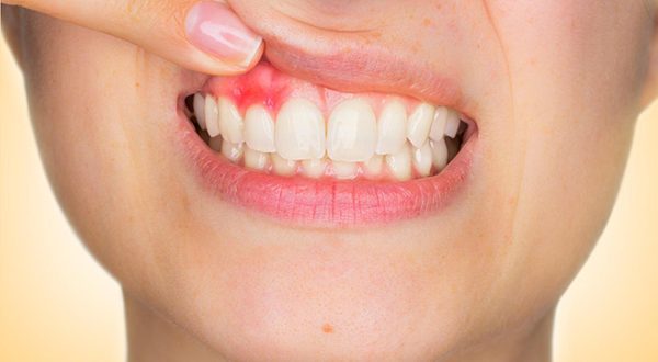 Câncer de boca deve atingir 14,7 mil novos casos no país este ano