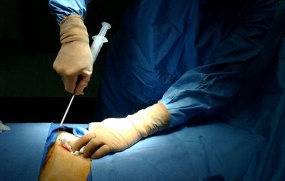 transplante de medula óssea 400x255 - Novo material pode substituir transplante de medula óssea, diz estudo