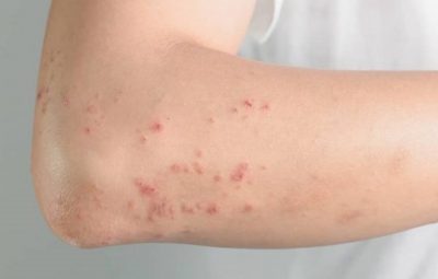 dermatite atopica 400x255 - Pacientes com dermatite atópica moderada a grave perdem até um mês de trabalho no ano por conta da doença