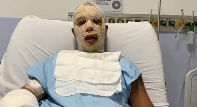 ‘Minhas filhas pediram para acender a fogueira’, diz prefeito que teve rosto queimado após explosão