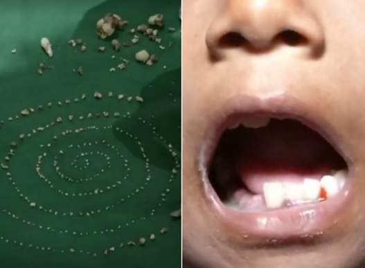 Médicos retiram 526 dentes da boca de menino de 7 anos durante cirurgia