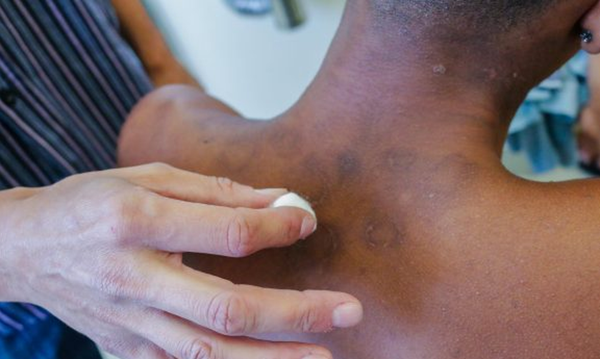 Brasil tem quase 30 mil novos casos de hanseníase por ano