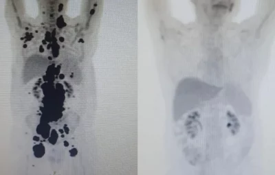 1684434403504689 400x255 - Paciente com câncer há 13 anos tem remissão completa em SP em um mês após terapia celular em estudo na rede pública