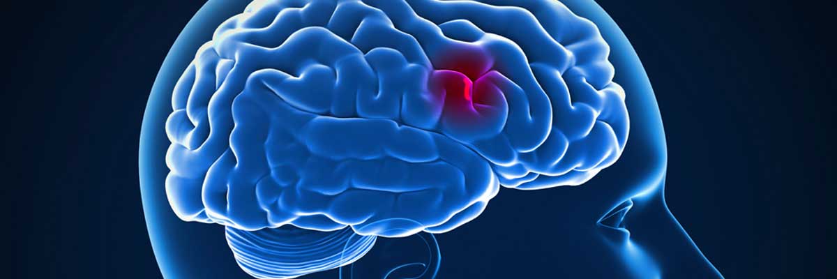 Hospital Unimed implanta Protocolo de AVC para sistematizar atendimento e prevenir sequelas em pacientes