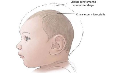 Microcefalia 400x255 - Crianças com microcefalia fruto do maior surto de zika do Brasil completam dois anos de idade; ONG Visão Mundial auxilia famílias após mobilização em resposta à epidemia