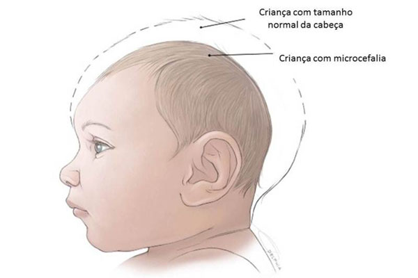 Crianças com microcefalia fruto do maior surto de zika do Brasil completam dois anos de idade; ONG Visão Mundial auxilia famílias após mobilização em resposta à epidemia