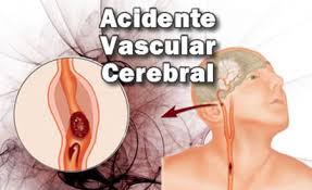 acidente vascular cerebral AVC - Socorro rápido à pessoa com AVC pode evitar até 100 mil óbitos por ano