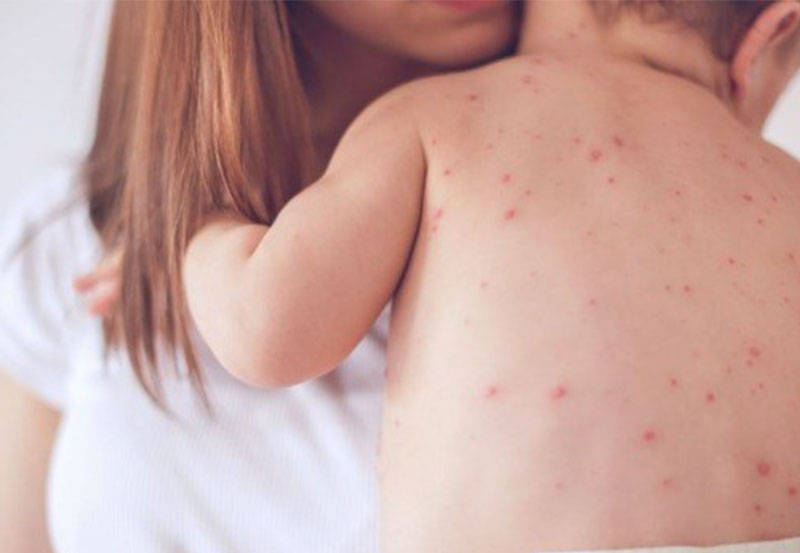 Brasil tem 677 casos de sarampo confirmados, diz Ministério da Saúde