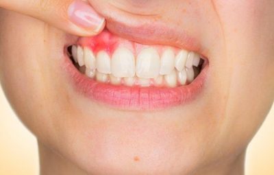 cancer de boca 400x255 - Câncer de boca deve atingir 14,7 mil novos casos no país este ano