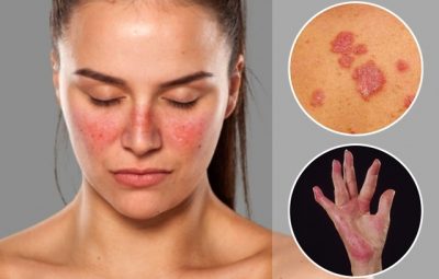 Dia Internacional de Atenção à Pessoa com Lúpus doença atinge cerca de 200 mil brasileiros segundo MS 400x255 - Dia Internacional de Atenção à Pessoa com Lúpus: doença atinge cerca de 200 mil brasileiros, segundo MS